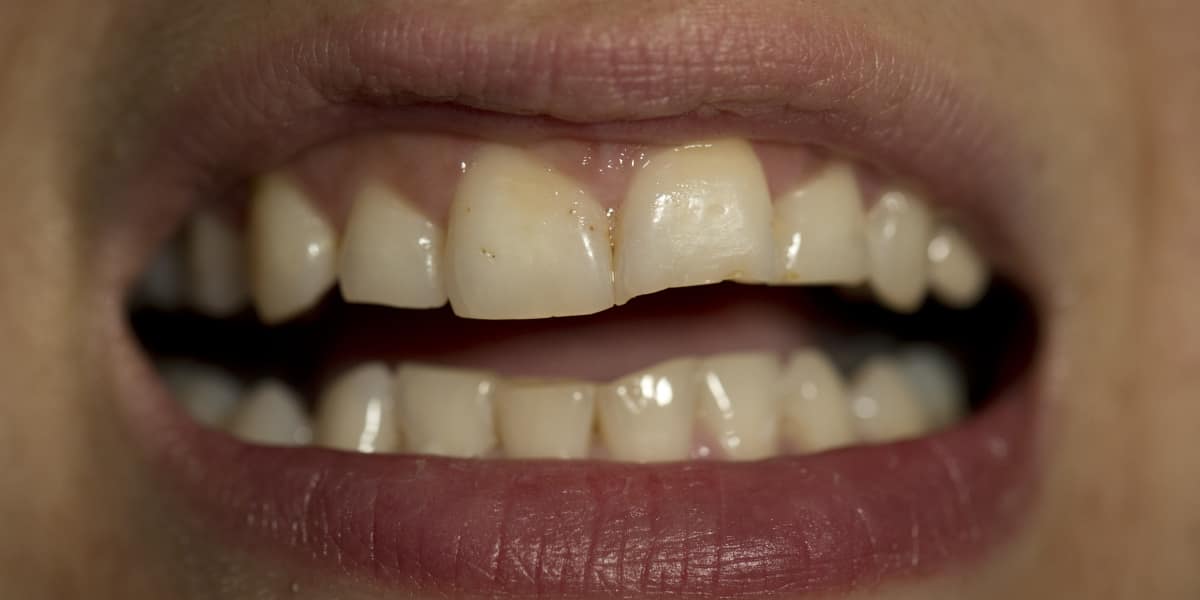 Usmívající se ústa s mezerou mezi předními zuby.