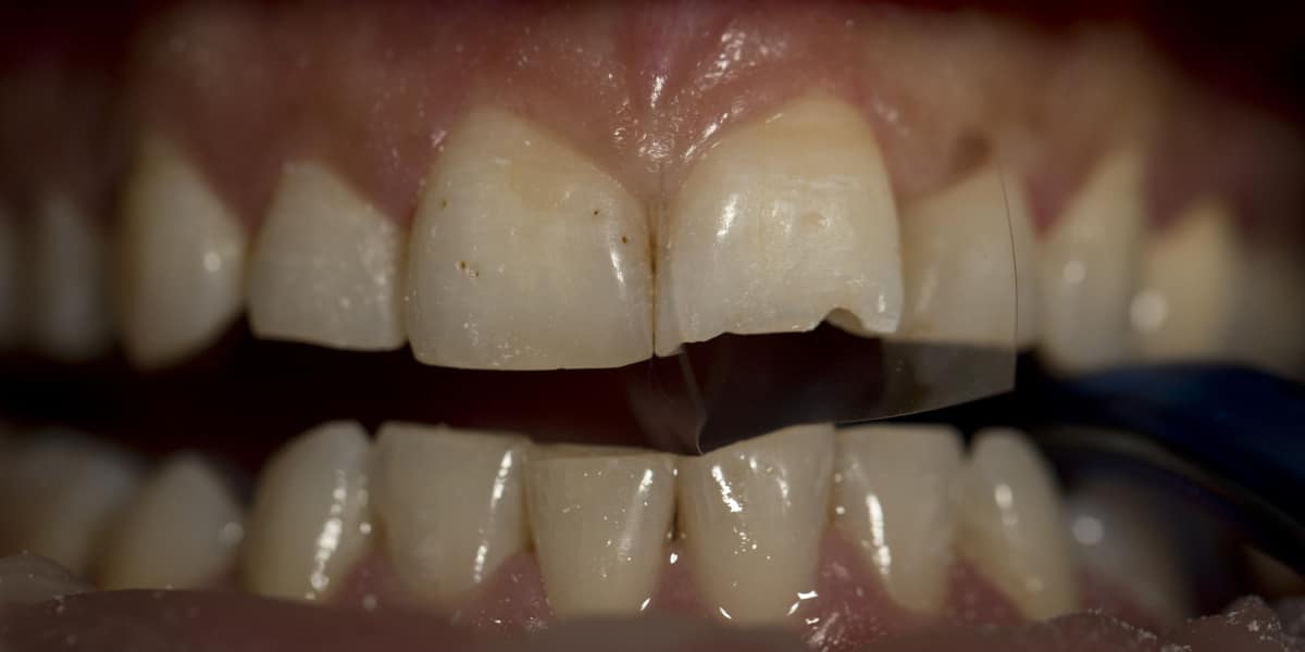 Detailní záběr na zuby s prasklým předním zubem a zubním nástrojem.